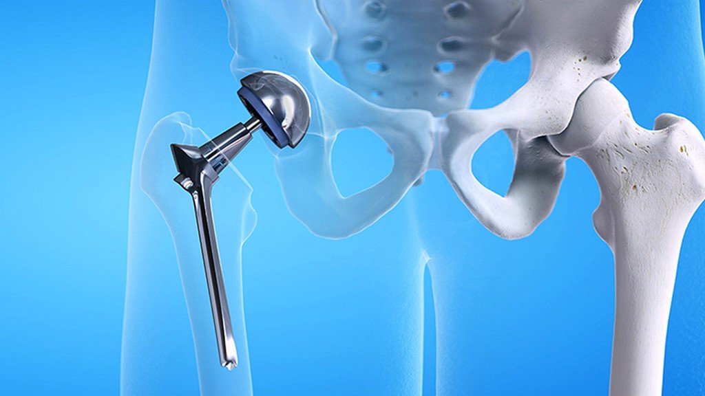 Prótesis de Rodilla y Cadera